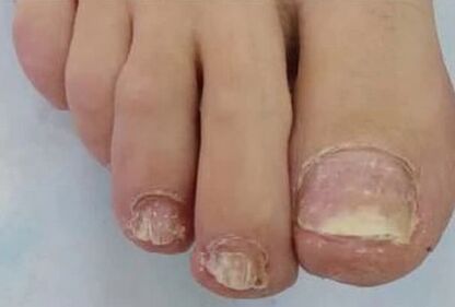 The nails were much affected by the fungus