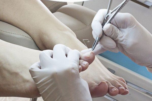 Mechanical removal of nails affected by the fungus