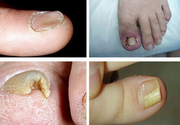 Symptoms of onicomycosis in the legs