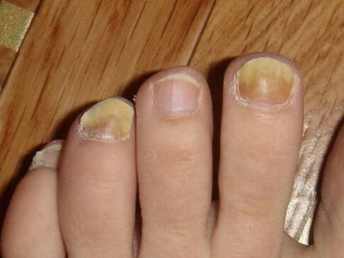 Foot fungus with nail damage